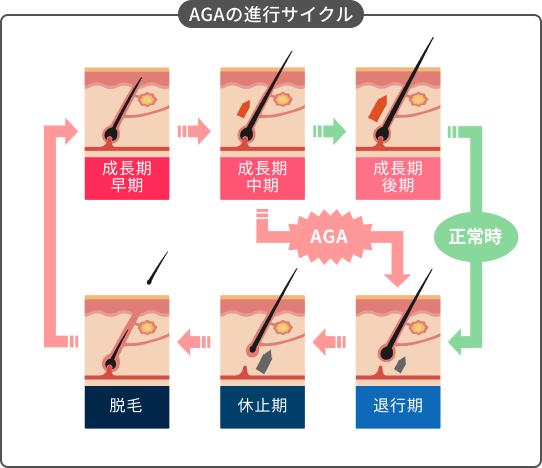AGAの進行サイクルグラフ