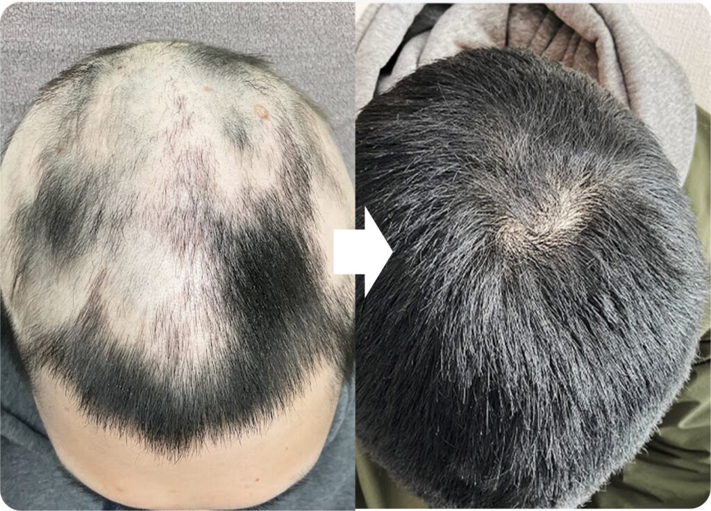 治療法❸：円形脱毛症の治療